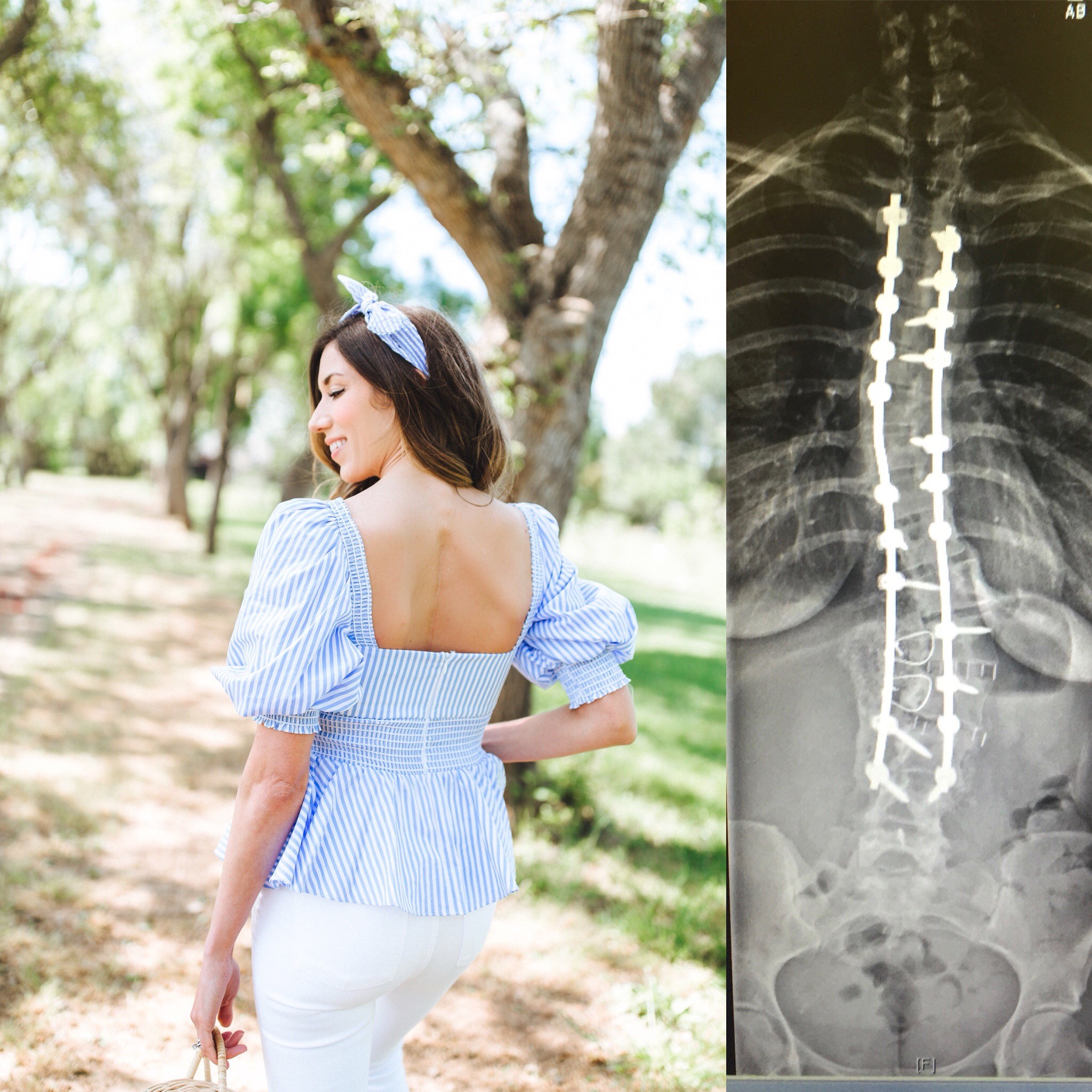 3 Prayers for Scoliosis – Hope for My Scoliosis